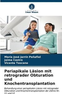 bokomslag Periapikale Lsion mit retrograder Obturation und Knochentransplantation