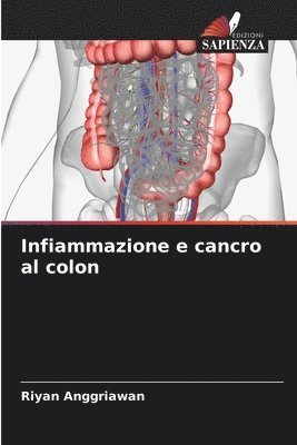 Infiammazione e cancro al colon 1