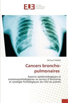 Cancers broncho-pulmonaires 1