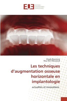 Les techniques d'augmentation osseuse horizontale en implantologie 1