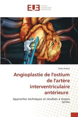 bokomslag Angioplastie de l'ostium de l'artre interventriculaire antrieure