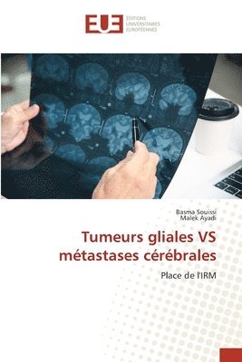 bokomslag Tumeurs gliales VS mtastases crbrales