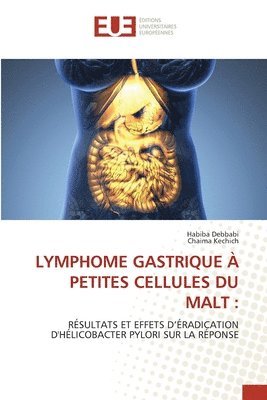 Habiba Debbabi, Chaima Kechich - Lymphome Gastrique À Petites Cellules Du Malt, Häftad