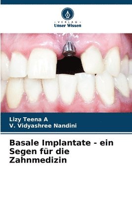 Lizy Teena A, V Vidyashree Nandini, V. Vidyashree Nandini - Basale Implantate - ein Segen für die Zahnmedizin, Häftad