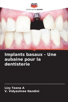 Lizy Teena A, V Vidyashree Nandini, V. Vidyashree Nandini - Implants basaux - Une aubaine pour la dentisterie, Häftad