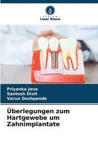 bokomslag berlegungen zum Hartgewebe um Zahnimplantate