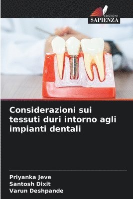 Considerazioni sui tessuti duri intorno agli impianti dentali 1