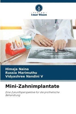 Mini-Zahnimplantate 1
