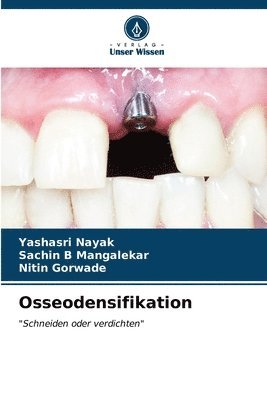 Osseodensifikation 1