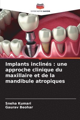 Implants inclins 1