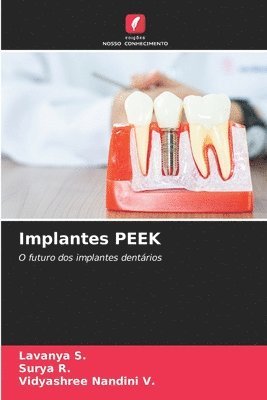 Implantes PEEK 1