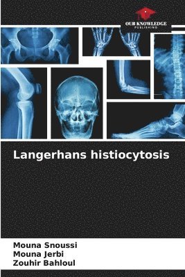 Langerhans histiocytosis 1