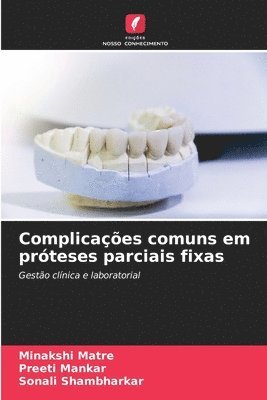 Complicaes comuns em prteses parciais fixas 1