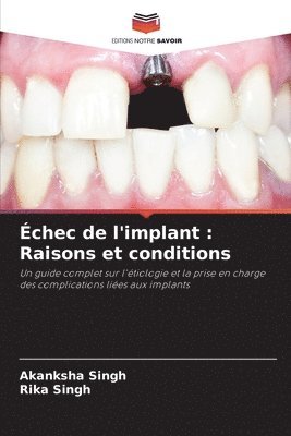 bokomslag Échec de l'implant