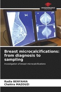 bokomslag Breast microcalcifications
