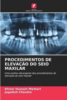 bokomslag Procedimentos de Elevao Do Seio Maxilar