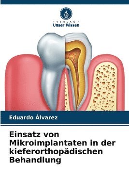 bokomslag Einsatz von Mikroimplantaten in der kieferorthopdischen Behandlung