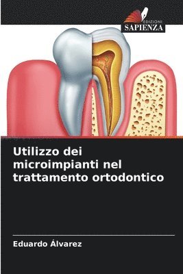 Utilizzo dei microimpianti nel trattamento ortodontico 1