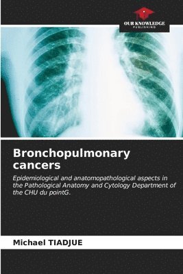 bokomslag Bronchopulmonary cancers