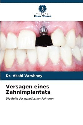 Versagen eines Zahnimplantats 1