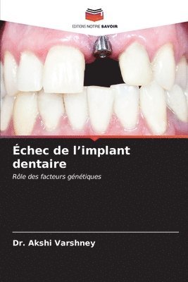 bokomslag chec de l'implant dentaire