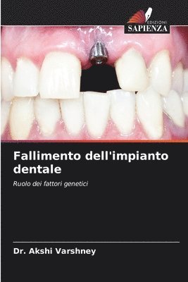 bokomslag Fallimento dell'impianto dentale