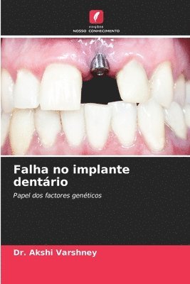 bokomslag Falha no implante dentrio