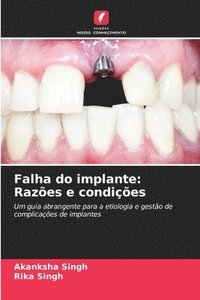 bokomslag Falha do implante: Razões e condições