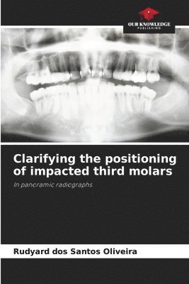 Clarifying the positioning of impacted third molars 1
