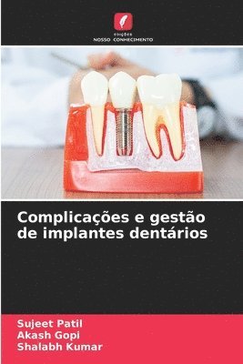 bokomslag Complicaes e gesto de implantes dentrios