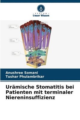 Urmische Stomatitis bei Patienten mit terminaler Niereninsuffizienz 1