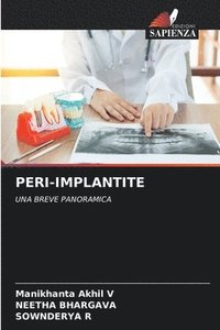bokomslag Peri-Implantite