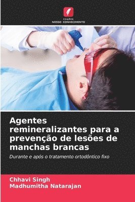 Agentes remineralizantes para a prevenção de lesões de manchas brancas