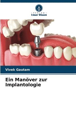 bokomslag Ein Manver zur Implantologie