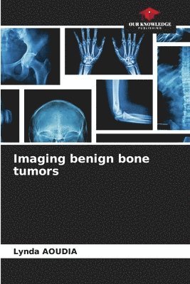 bokomslag Imaging benign bone tumors