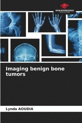 Imaging benign bone tumors 1