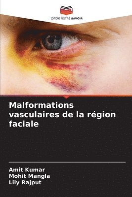 Malformations vasculaires de la rgion faciale 1