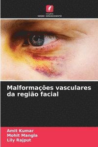 bokomslag Malformações vasculares da região facial