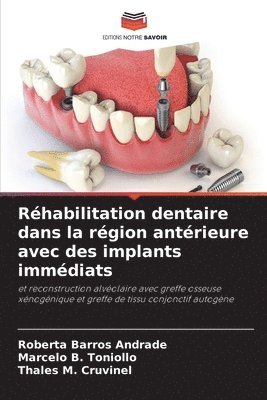 bokomslag Rhabilitation dentaire dans la rgion antrieure avec des implants immdiats