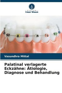 bokomslag Palatinal verlagerte Eckzähne: Ätiologie, Diagnose und Behandlung