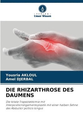 Die Rhizarthrose Des Daumens 1