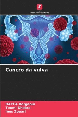 Cancro da vulva 1