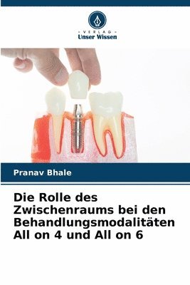 Rolle des Zwischenraums bei den Behandlungsmodalitäten All on 4 und All on 6