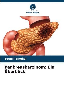 Pankreaskarzinom 1