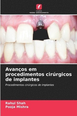 Rahul Shah, Pooja Mishra, RAHUL SHAH - Avanços em procedimentos cirúrgicos de implantes, Häftad