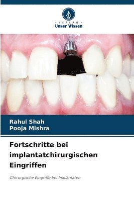 bokomslag Fortschritte bei implantatchirurgischen Eingriffen