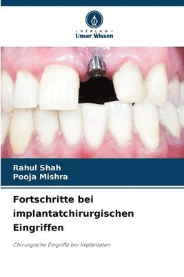 Rahul Shah, Pooja Mishra, RAHUL SHAH - Fortschritte bei implantatchirurgischen Eingriffen, Häftad