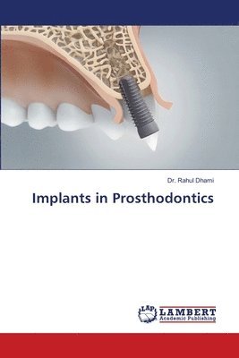 bokomslag Implants in Prosthodontics