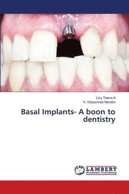 Basal Implants- A boon to dentistry 1