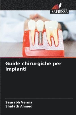 bokomslag Guide chirurgiche per impianti